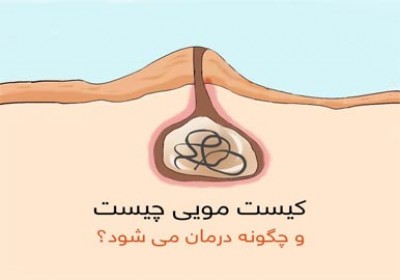 دلایل ایجاد و روشهای درمان کیست مویی