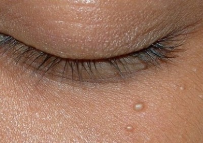 دانه‌های چربی اطراف چشم چیست؟