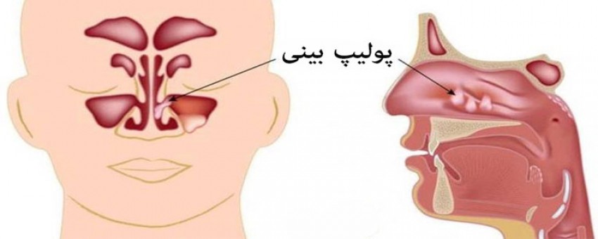 پولیپ بینی چیست و چگونه شکل می‌گیرد؟