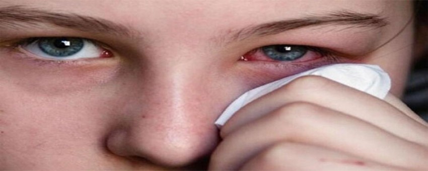 عفونت چشمی با لنزهای تماسی