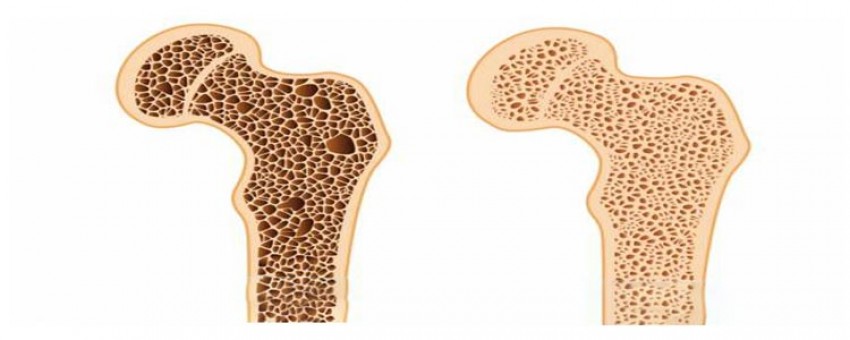 پوکی استخوان چیست؟؟