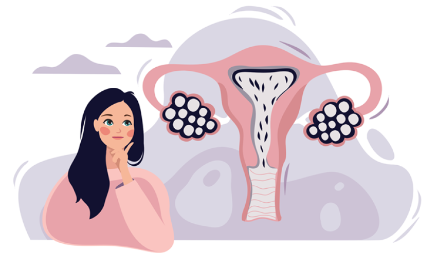 همه چیز درباره سندرم تخمدان پلی کیستیک (PCOS)