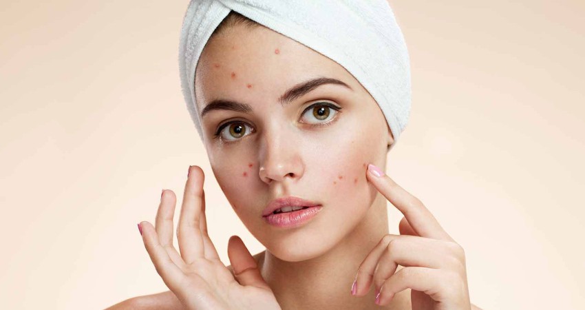 قرص  لیورگل  چه تاثیری بر جوش های صورت دارد؟