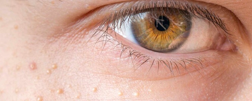 میلیا چیست؟ بهترین بررسی علل ایجاد آن