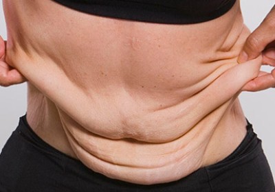 علت شل شدن پوست بعد از کاهش وزن چیست؟